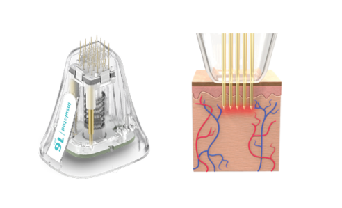 Microneedling Machine | Potenza™ | Cynosure